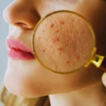 una ragazza con la lente di ingrandimento sulla pelle irritata