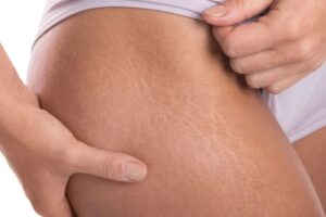 donna con smagliature sulla coscia