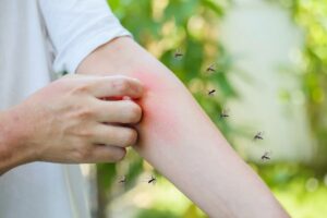 Persona che si gratta il braccio mentre viene punta dalle zanzare