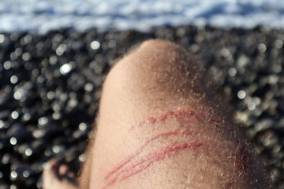 gamba di uomo con puntura di medusa