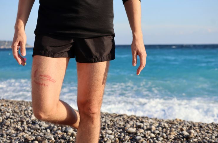 uomo con una puntura di medusa su una coscia